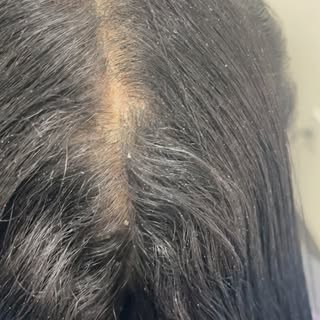 🦠Seborrheic dermatitis 
🦠 Psoriasis 
🦠Eczema 
Are a few scalp diseases that can cause hair loss i