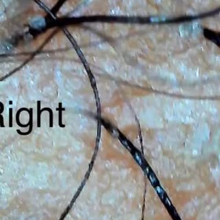 Blocked follicles can’t function.

These before-and-after images show what happens when seb-derm and
