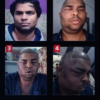 Kanpur HAIR TRANSPLANT Death सर्जरी से पहले ये 5 बातें ज़रूर जान लें | Hair Transplant Results

****