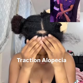 🚨 Traction alopecia is one of the few types of hair loss that is largely preventable.

Traction alo