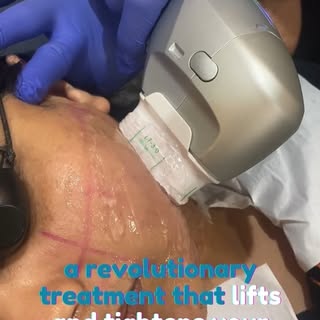 Want tighter, firmer skin without surgery? Meet HIFU – High-Intensity Focused Ultrasound a revolutio
