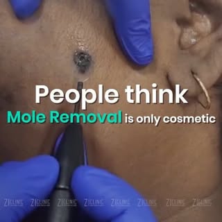 Sometimes, it's the smallest details that make the biggest difference.

A safe, precise mole removal