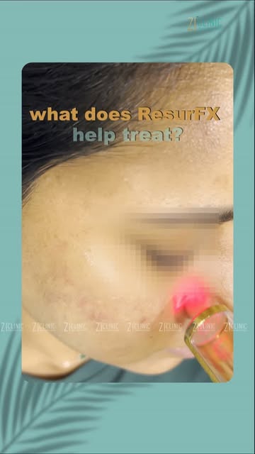 ResurFX laser is designed to address a wide range of skin concerns, while enhancing overall skin tex