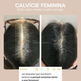 A calvície feminina vai muito além dos fios. Ela impacta autoestima, identidade e confiança.

Essa p