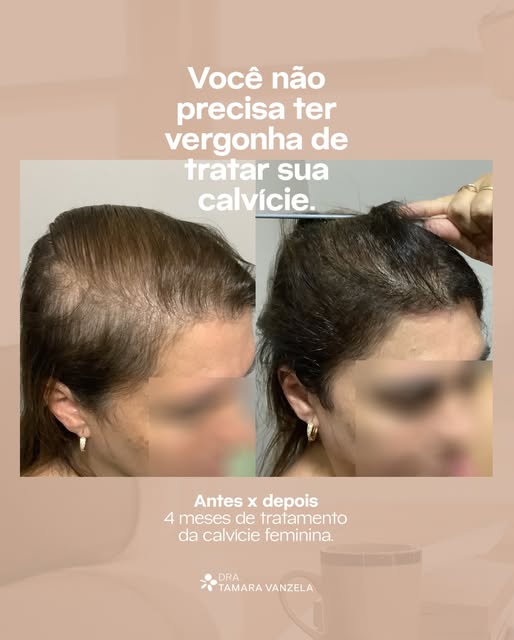 Você não precisa ter vergonha de tratar sua calvície.

Mas eu sei que essa vergonha existe, conheço 