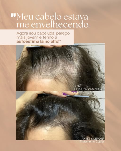 Sabe o que mais me marca nos relatos das minhas pacientes? Não é a queda ou afinamento do cabelo em 