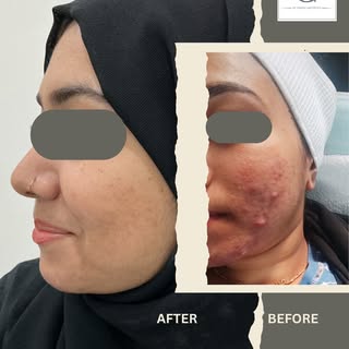 Discover the transformation! ✨ Unlock the secret to acne free, nourished skin with the right regimen