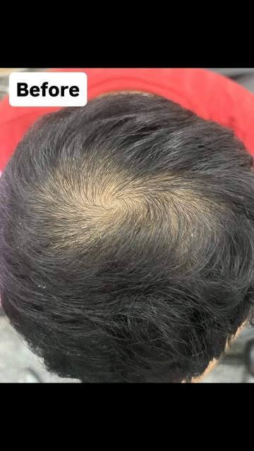✨ Happy patients, healthy hair! ✨
Another beautiful Hair PRP journey with visible results and a very