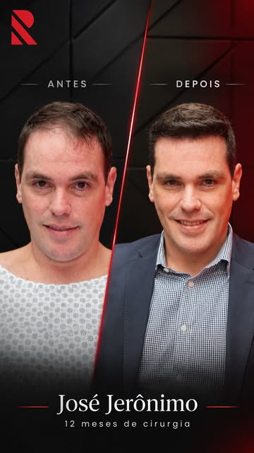 Meu amigo José Jerônimo!

12 meses e 6200 folículos separam um momento ao outro. 
Que jornada! 👏🏻