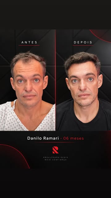 06 meses, 16mil fios de cabelo e um lapso que parece um verdadeiro túnel do tempo.

Muito obrigado p