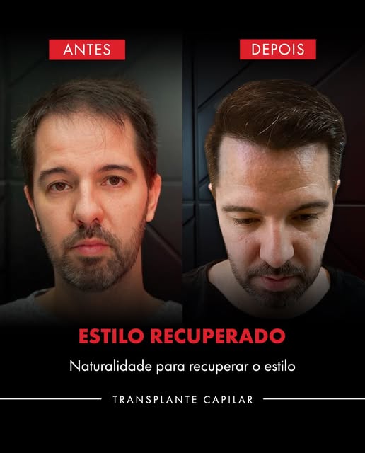 Dois desafios em uma única cirurgia: Entradas e coroa no mesmo procedimento.

Esse paciente queria p