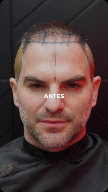 A calvície estava mudando a forma como ele se enxergava.

Hoje, o espelho conta outra história.

Cad