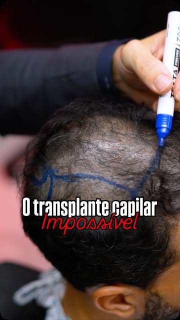 Um caso extremamente desafiador.

Nosso paciente apresenta uma área calva extensa e já passou por du