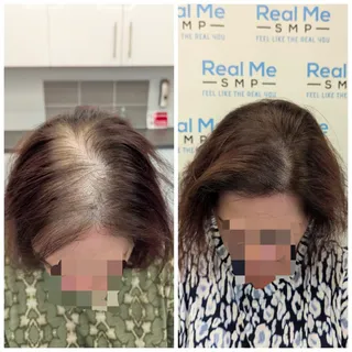 Before and After SMP correction 🚫 Before not my work.
This client had previously had SMP that was l