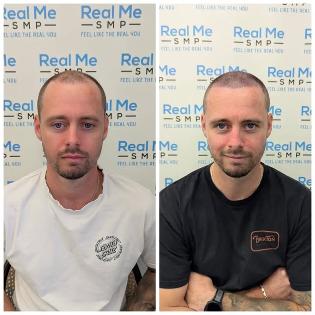 Before ➡️ After SMP 💥 

💙 SMP is a cosmetic tattoo used to disguise thinning hair
💙 Immediate res