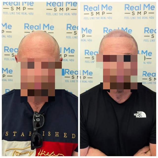 Before ➡️ After SMP 💥 

💙 SMP is a cosmetic tattoo
💙 Immediate results after the first session 
�