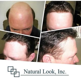 #hairreplacements #hairreplacementspecialist #hairlosssolutions #nonsurgicalhair #nonsurgicalhairres