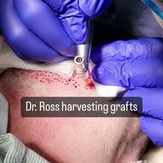 Here you can see Dr. Ross harvesting grafts for a hair transplant using a small instrument that's si