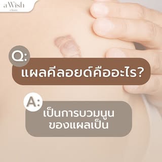 #แผลคีลอยด์กับการศัลยกรรมตัดหน้าอก
วันนี้อะวิชเอาเกร็ดความรู้เล็กๆมาฝากลูกเพจกันค่ะ ใครที่กำลังลังเล