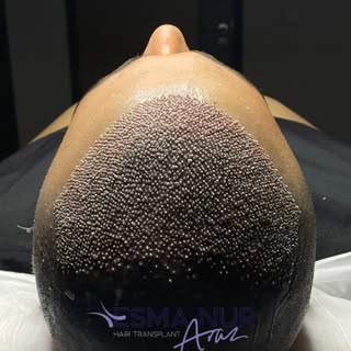 Esma Nur Araz Saç Ekim Merkezi / Hair Transplant
Bölgenin
En İyi Saç Ekim Merkezi
✅ Whatsapp: 0540 1
