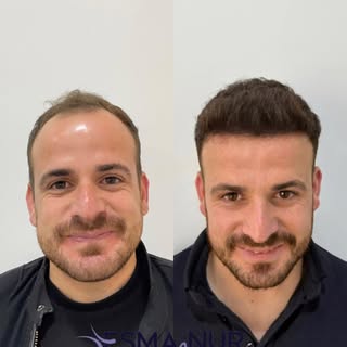 Esma Nur Araz Saç Ekim Merkezi / Hair Transplant
Bölgenin
En İyi Saç Ekim Merkezi
✅ Whatsapp: 0540 1