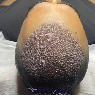 Esma Nur Araz Saç Ekim Merkezi / Hair Transplant
Bölgenin
En İyi Saç Ekim Merkezi
✅ Whatsapp: 0540 1