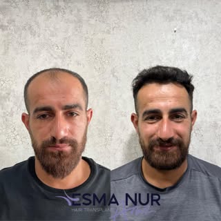 Esma Nur Araz Saç Ekim Merkezi / Hair Transplant
Bölgenin
En İyi Saç Ekim Merkezi
✅ Whatsapp: 0540 1