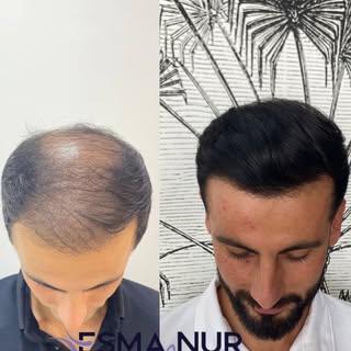 Esma Nur Araz Saç Ekim Merkezi / Hair Transplant
Bölgenin
En İyi Saç Ekim Merkezi
✅ Whatsapp: 0540 1