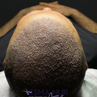 Esma Nur Araz Saç Ekim Merkezi / Hair Transplant
Bölgenin
En İyi Saç Ekim Merkezi
✅ Whatsapp: 0540 1