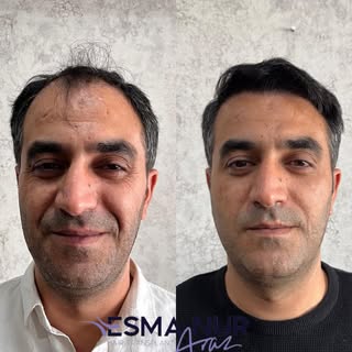 Esma Nur Araz Saç Ekim Merkezi / Hair Transplant
Bölgenin
En İyi Saç Ekim Merkezi
✅ Whatsapp: 0540 1