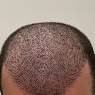 Esma Nur Araz Saç Ekim Merkezi / Hair Transplant
Bölgenin
En İyi Saç Ekim Merkezi
✅ Whatsapp: 0540 1