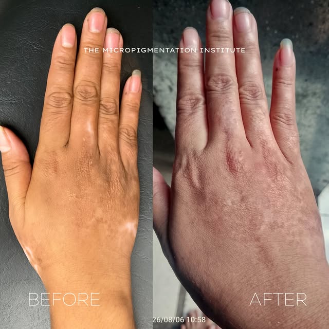 SCARS DON’T HAVE TO DEFINE HOW YOU FEEL ABOUT YOUR SKIN. 
Scar Camouflage is a specialized micropigm