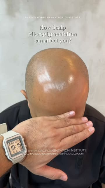 For someone dealing with thinning hair, baldness, alopecia, or scalp scars, SMP can do more than cre