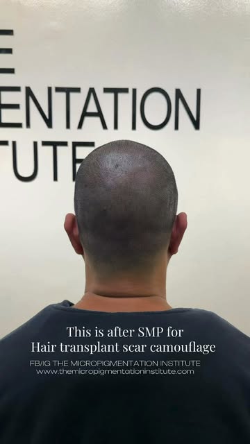 Had a hair transplant but still bothered by the donor-area scars?
SMP isn’t just for creating the ap