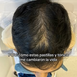 Comencé a perder cabello y esto me ayudó a volver tenerlo de nuevo en menos de 6 meses y lo quiero c