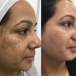 🌟 Understanding Pigmentation! 🌟 

Did you know that pigmentation changes don’t always appear right