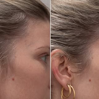 ✨Transform your Hair journey with Tricholase Fractional & HAIRestart Laser Restoration at Princeton 