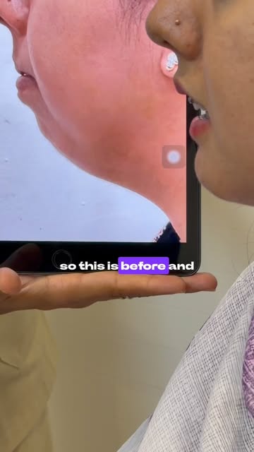 ✨ 2 Months After Genioplasty — A Beautiful Transformation! ✨

From a short, recessed chin to a more 