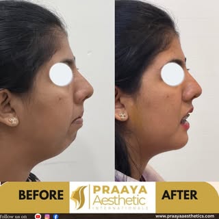 ✨ A Remarkable Genioplasty Transformation ✨

A young woman with a severely retruded chin wanted bett