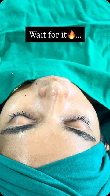 👃🏻 SEPTO-RHINOPLASTY TRANSFORMATION | FROM DUBAI

A beautiful transformation for our lovely patien
