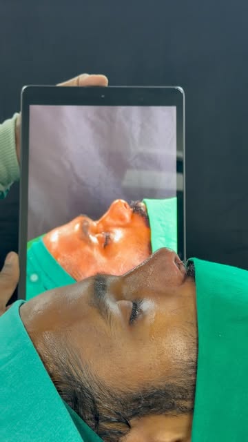 ON-TABLE RHINOPLASTY REVEAL | DEPRESSED & FLAT NOSE 👃🏻

A remarkable Rhinoplasty transformation re