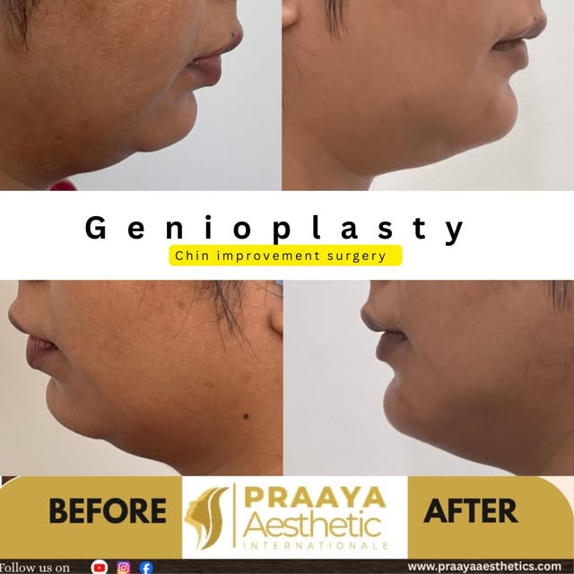 ✨ GENIOPLASTY | BEFORE & AFTER TRANSFORMATION

A beautiful before-and-after transformation following