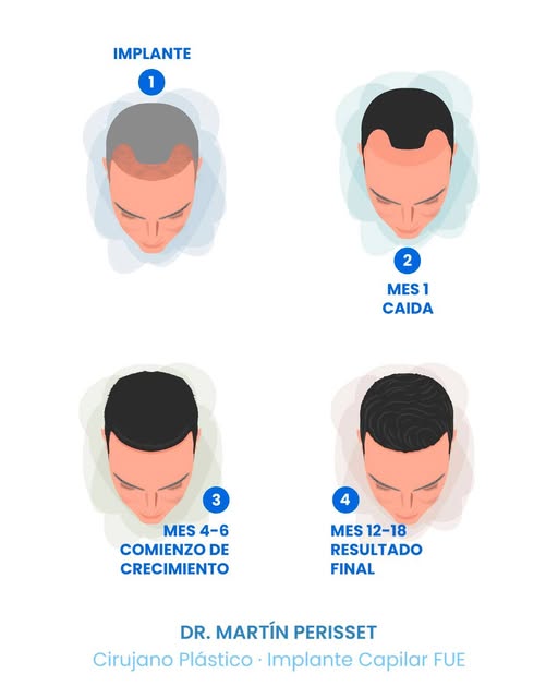 Se cayó el cabello que me trasplantaron. ¿Qué está pasando?

Es la consulta que más recibo entre el 