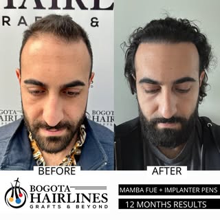 Before and after A Hair transplant by Dr Paola Pareja 

2805 Grafts implanted with focus on hairline