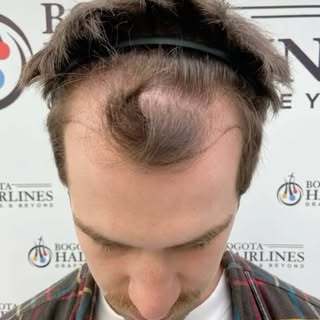 How does A Hair Transplant look like 0-12 months? #bogotahairlines #hairtransplant #transplantecapil