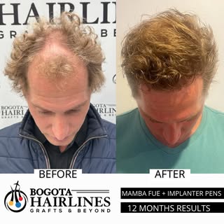 Before and after A Hair transplant by Dr Sergio Camacho and Dr Gina Carranza 🇨🇴

3049 Grafts impla
