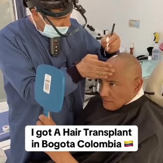 🚨Before and after A hair transplant #bogotahairlines #hairtransplant #hairtransplantcolombia #trans