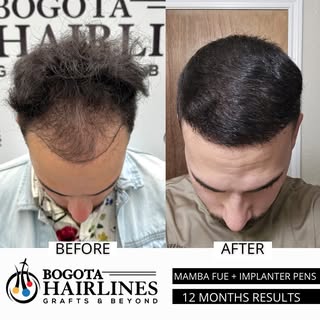 Before and after A Hair transplant by Dr Sergio Camacho and Dr Paola Pareja 🇨🇴

3072 Grafts implan