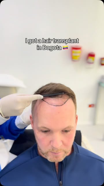Before and after A Hair Transplant in bogota 🇨🇴 #bogotahairlines #hairtransplant #transplantecapil