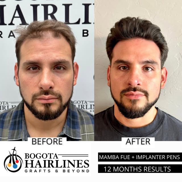 1 Year Hair transplant result done by #Bogotahairlines

3012 Grafts implanted with focus on the hair
